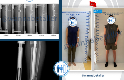 8.5cm Growth: The Limb Lengthening Journey of Our Turkish Patient